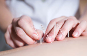 acupuntura na Kinex Fisioterapia