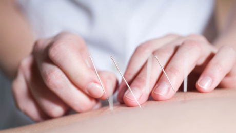 acupuntura na Kinex Fisioterapia